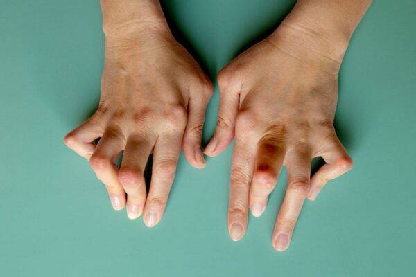 What is the Main Cause of Rheumatoid Arthritis?