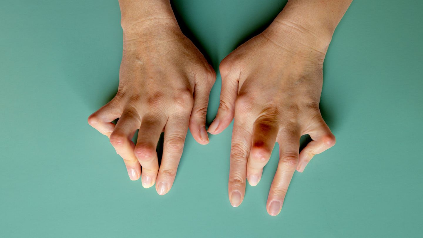 What is the Main Cause of Rheumatoid Arthritis?